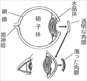 角膜移植・アイバンク